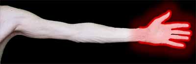 Paresthesia on the hand