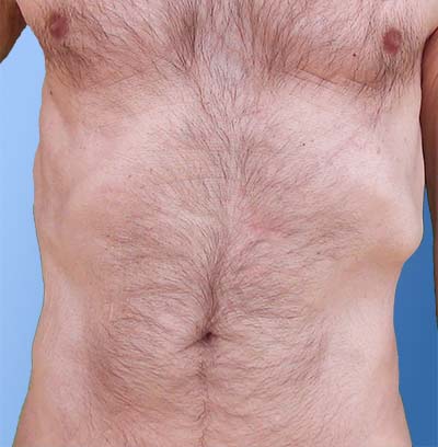 Vertical center fold on abdomen