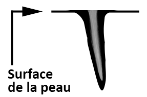 Croisement de plis qui s'enfonce dans la peau