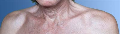 Diagonal folds in the neck area