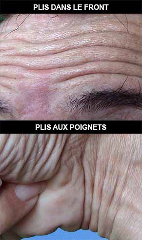 Plis cutanés sur le front et les poignets