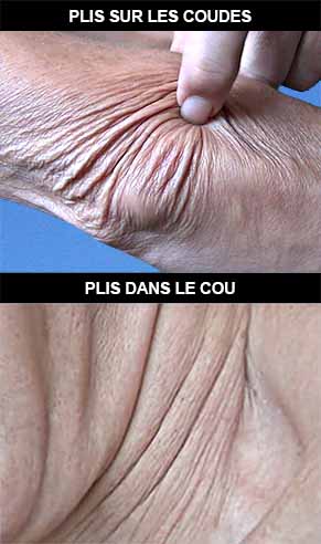Plis cutanés sur les coudes et dans le cou