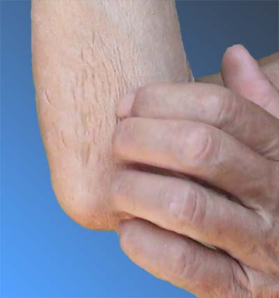 Le toilettage à quatre doigts laisse de nombreuses marques d'ongle