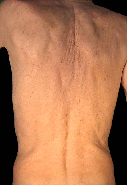 Fold on the vertebral column