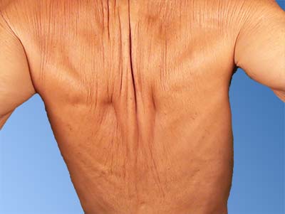 Vertical folds in the back