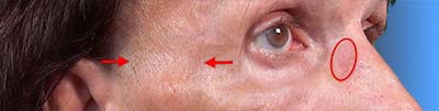 Wear folds on the nose